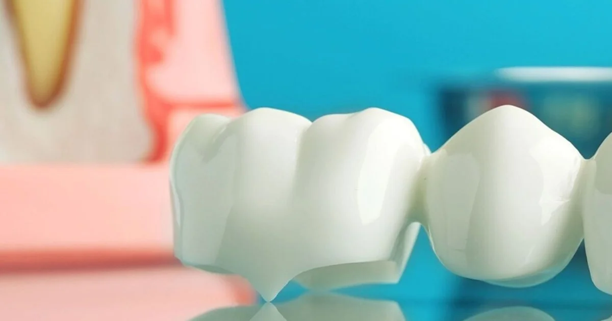 Dental Crowns and Bridges - When You Need One and What to Expect