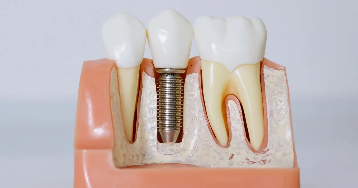 Dental Implants Western Sydney - The Complete Guide