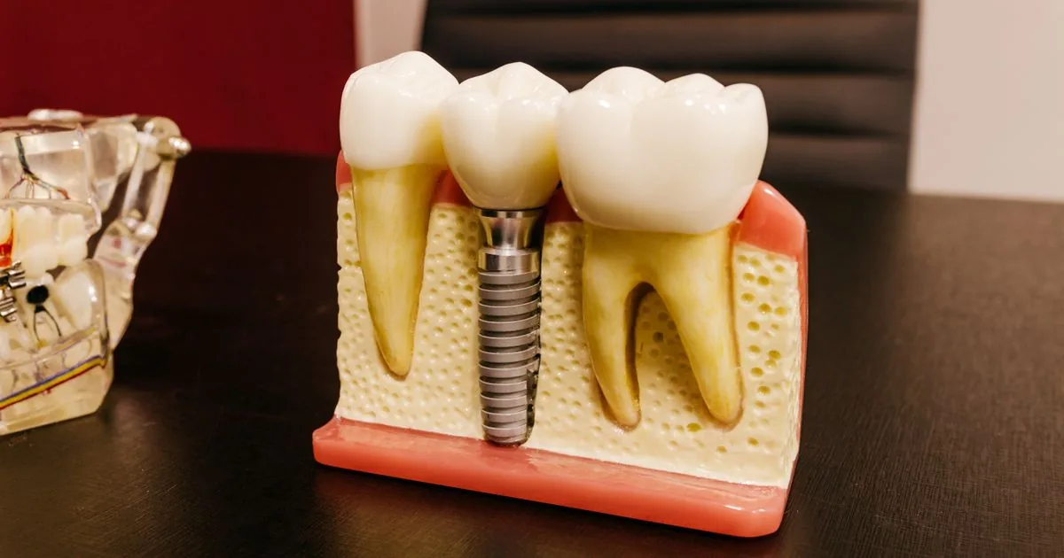 Dental Implants Near Orchard Hills - What to Expect