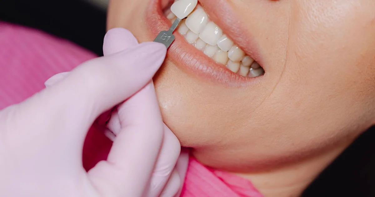 Porcelain Veneers - The Complete Guide for Western Sydney Patients