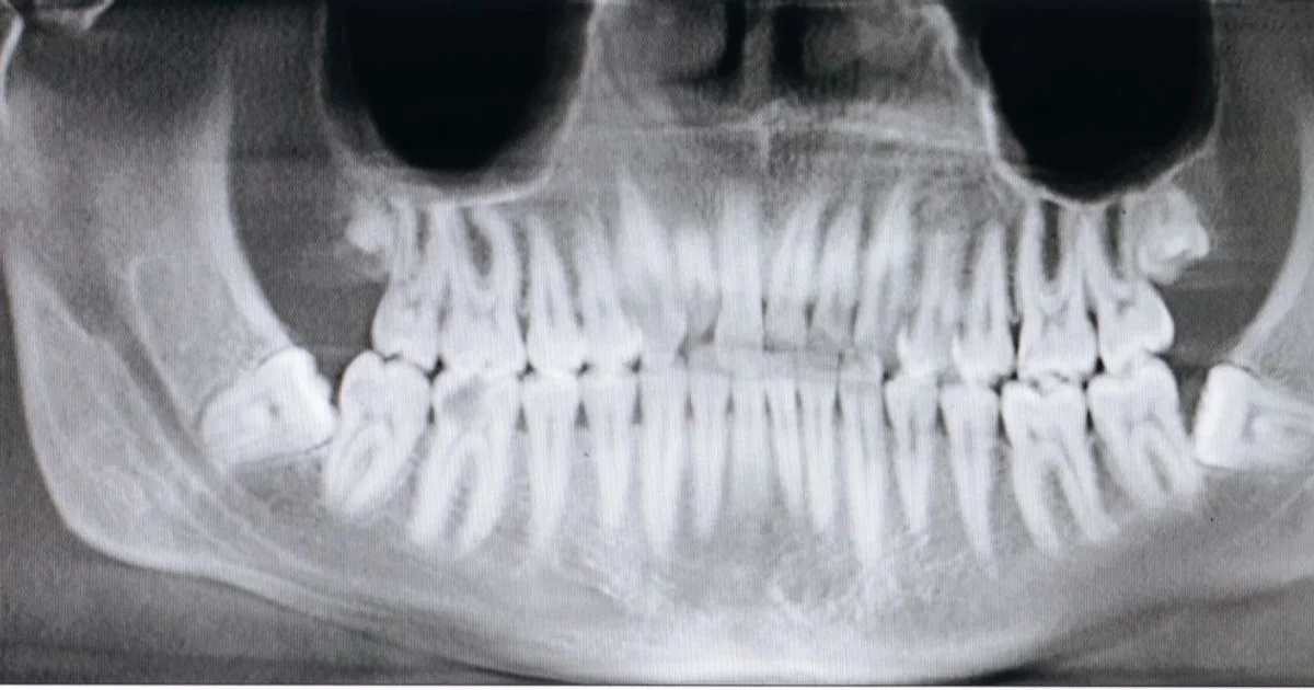 Wisdom Teeth Removal - What to Expect Before, During and After